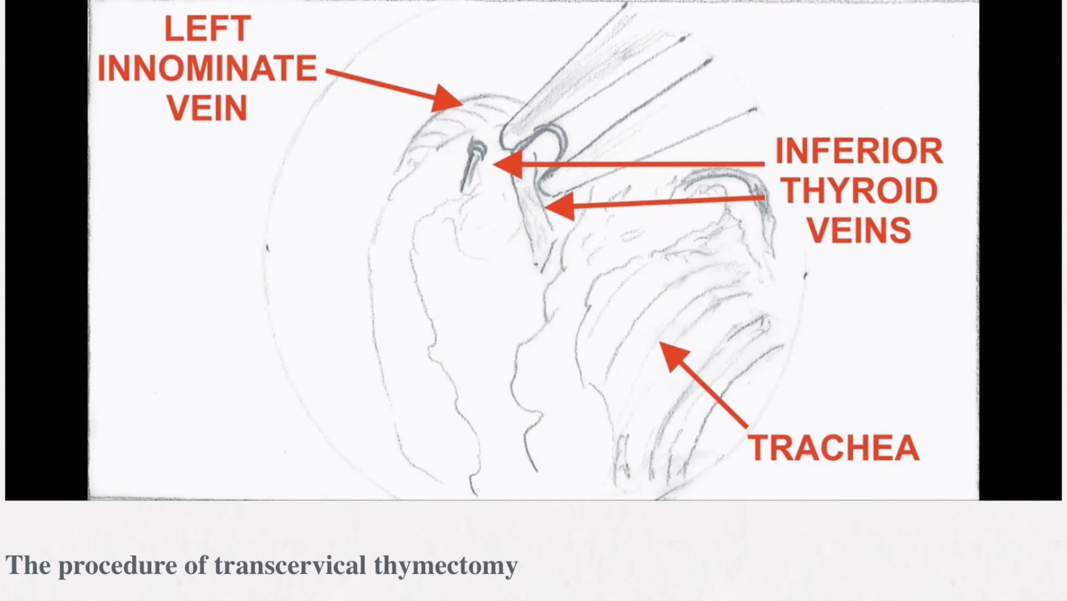 ITMIG Minimally Invasive Thymectomy